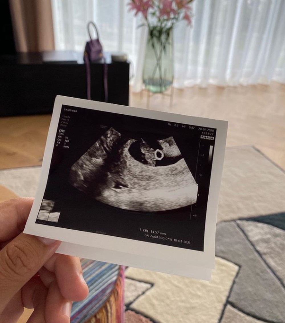 Soňa Skoncová a jej snúbenec sa stanú rodičmi