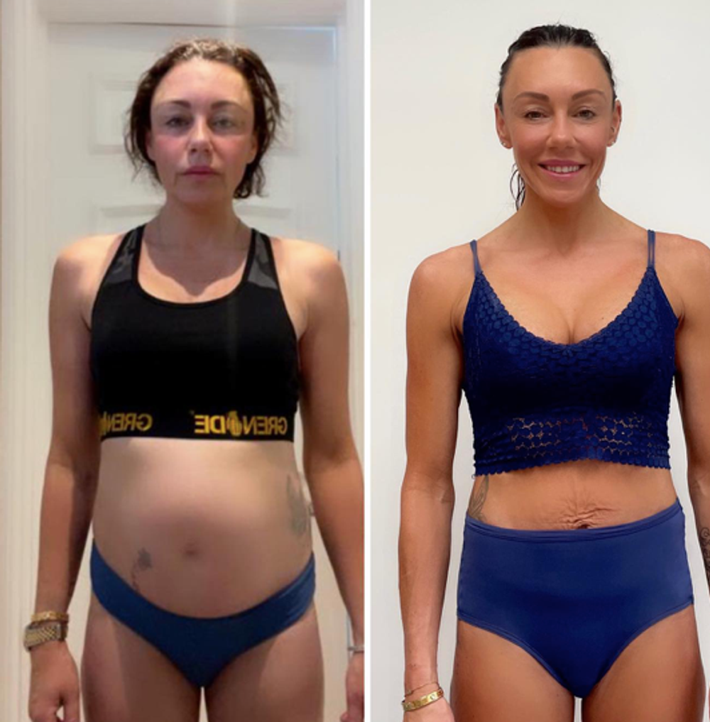 Michelle Heaton naľavo v prvý deň liečby a vpravo 9 mesiacov bez alkoholu