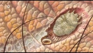 Svrab ako neželaný suvenír z dovolenky. Ako sa mu vyhnúť?