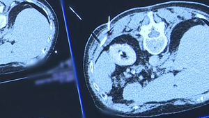 Rýchlejšie liečenie nádorov? Pomôže pri ňom mráz