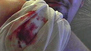 5 mýtov a faktov o ošetrovaní rán: Robili ste to doteraz správne?