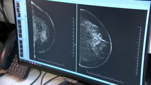 Štát posiela ženám pozvánky na mamografiu