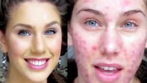 Akné trápi aj dospelých. Zbaviť sa ho chce každý