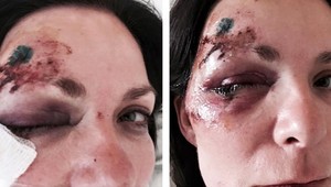 Anna K.: Ukázala, ako vyzerá jej dobitá tvár