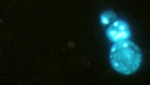 Neznáma hrozba. Nepodceňujte príznaky nevyliečiteľnej rakoviny