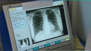 Vedci prvýkrát objavili mikroplasty v pľúcach živých ľudí