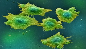 Za rakovinu prostaty môže infekcia, tvrdia vedci