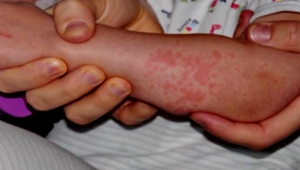 Očkovanosť proti osýpkam klesla. Odborníci upokojujú, že vakcína je bezpečná