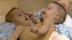 Siamské dvojčatá úspešne oddelili, operácia trvala 6 hodín