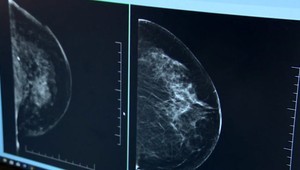 Skvelá správa: Lekári už dokážu určiť, u ktorej ženy sa rakovina prsníka po vyliečení  zopakuje