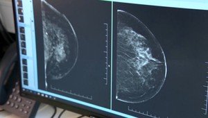 Koniec preventívnemu Sonu prsníkov. Podľa ministerstva u zdravých žien nie je spoľahlivé