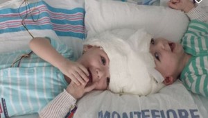 V New Yorku oddelili siamské dvojčatá, chlapci boli spojení hlavami