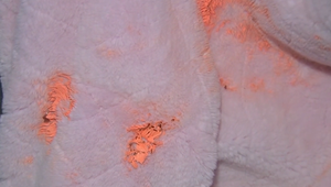 Dievča zasiahli paintballovou zbraňou do oka. O zrak prišlo natrvalo