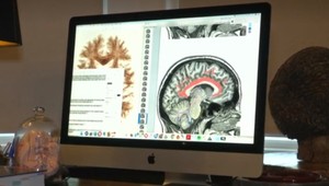 Zistili vám v dospelosti poruchu pozornosti? Vaše riziko demencie sa podľa vedcov významne zvyšuje