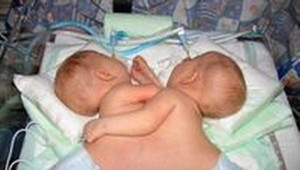 Siamské dvojčatá sú oddelené!
