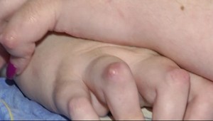 Zapálené kĺby: Nemusí to byť reuma, može to byť psoriatická artritída!