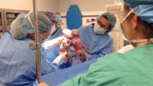 Nekonečná láska: Dvojičky sa po ťažkom pôrode držali za ruky!