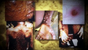 Odborníci odporúčajú nakúpiť vakcíny proti pravým kiahňam, ktoré sú účinné aj proti opičím kiahňam