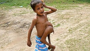 Chlapcovi vyoperovali parazitické dvojča