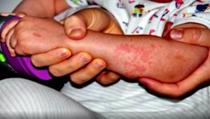 Na Slovensku zaregistrovali prvý prípad importovaných osýpok