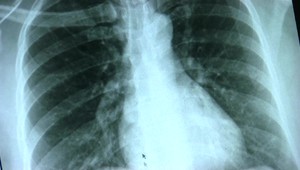 NENÁPADNÝ ZABIJAK:  Rakovinu pľúc ľudia často považujú za pretrvávajúcu infekciu