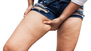 Ukladá sa vám tuk v stehnách? Pozor na srdce!