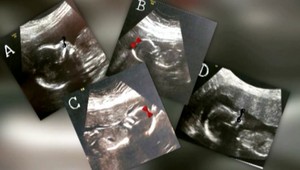 Tehotná žena zostala prekvapená. Namiesto jedného bude mať štyri bábätká