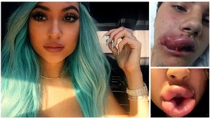 Strašné! Tínedžeri napodobňujú sestru Kim Kardashian, končia v nemocniciach!