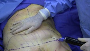 Tragédia! Mladá žena zomrela pri liposukcii