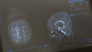 Botulotoxín môže pacientom po porážke vrátiť pohyb, no mnohí o tejto možnosti ani nevedia