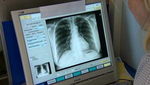 Choroba nórskej kráľovnej: Čo je to pľúcna fibróza?