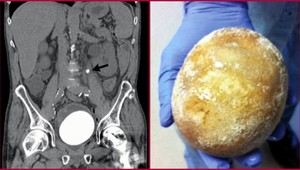 Muž sa sťažoval na bolesti. Z mechúra mu vybrali kameň veľký ako pštrosie vajce