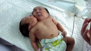 Šokovaní rodičia. Narodilo sa im dvojhlavé bábätko!