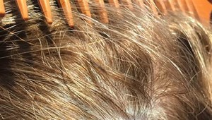 Predrakovinový stav kože má až 8 percent ľudí.  Ako nebezpečné lézie spoznáte?