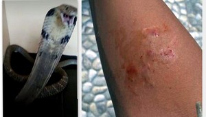 Chlapca pohrýzla kobra. S výzvou o pomoc pridal fotku na sociálnu sieť