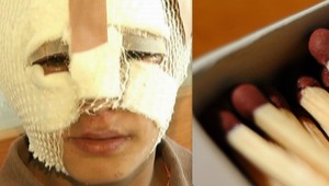 Václav (9) sa hral so zápalkami, neskončilo sa to dobre