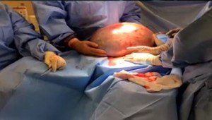 Kde všade V TELE môžete mať CYSTU? Nemusíte o nich ani vedieť