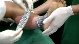 Neuveriteľné. Brazílski vedci liečia popáleniny pokožkou rýb