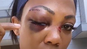 VIDEO: Prekrásnu športovkyňu napadol bezdomovec. Takmer prišla o OKO!