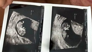 Výskumníci vyvíjajú ultrazvukové nálepky, ktoré vidia do vnútra tela