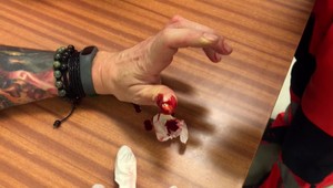 Dlho krvácate z rán a robia sa vám modriny? Kedy ísť k lekárovi?