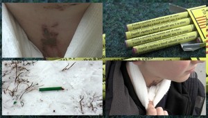 Hlúpy žart! Chlapcovi (9) hodili za golier petardu