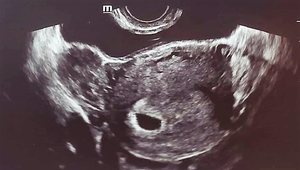 Drogy, nervové zrútenie, alkohol, láska proti vôli rodičov! A teraz je herečka TEHOTNÁ!