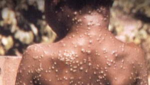 V Česku potvrdili ďalší prípad opičích kiahní