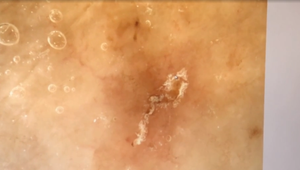 Opatrovateľka sa obáva prísť do práce. V domove sociálnych služieb sa šíri infekčná nákaza