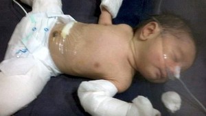 Novorodenec musel podstúpiť operáciu. Z tela mu vybrali jeho dvojča