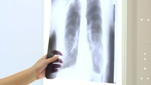 V kraji chýbajú pneumológovia, čakacie doby rastú. Rezort zdravotníctva chystá reformu odmeňovania