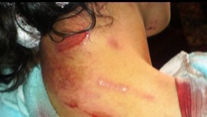 Dievča napadol v lese vlčiak, skončila v nemocnici