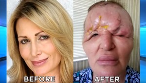 Američanka chcela spáchať samovraždu: Po plastike sa z krásky stalo monštrum!