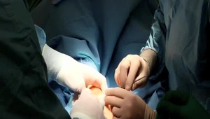 Žena mala silné bolesti v podbrušku a nekontrolovane priberala. Lekár jej objavil šokujúci nález